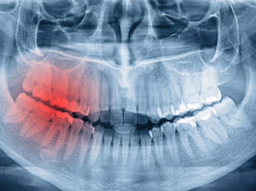 X-ray scan of teeth